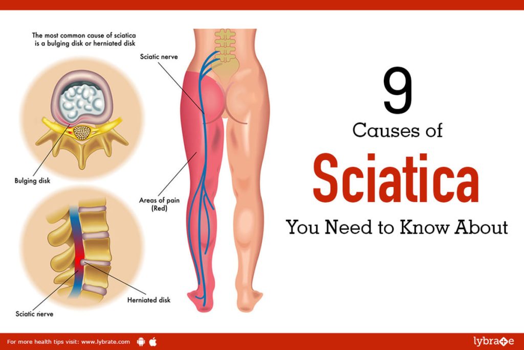 Download Sciatic nerve pain pictures 37 21104d