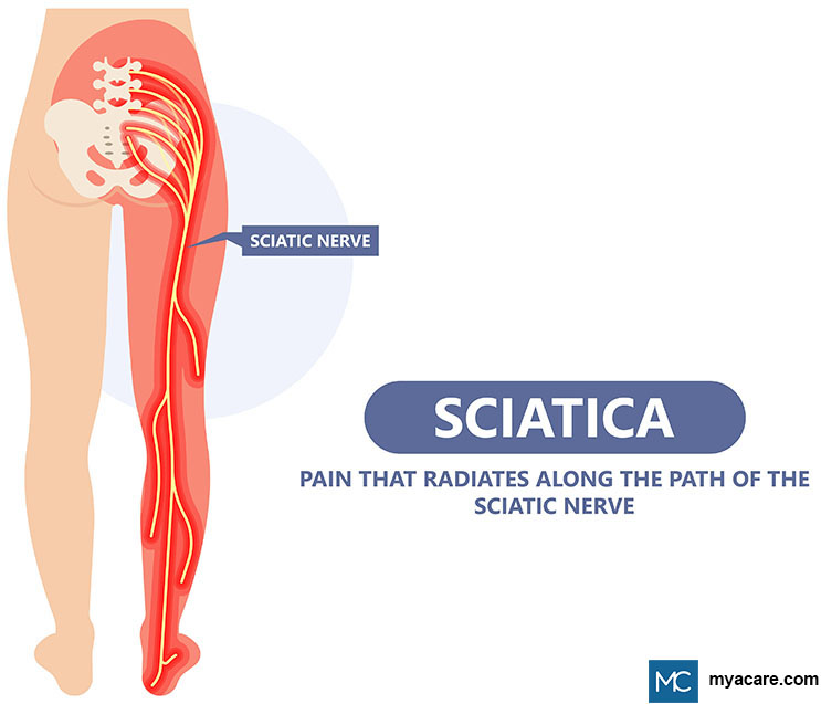 Download Sciatic nerve pain pictures 60 98c53cd4659740bfa52fa93944a9c653
