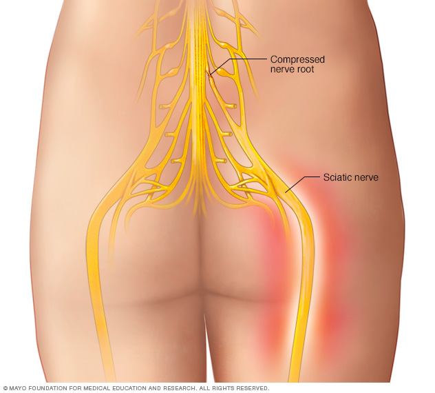 Download Sciatic nerve pain pictures 43 DS00516 IM02917 mcdc sciaticathu jpg