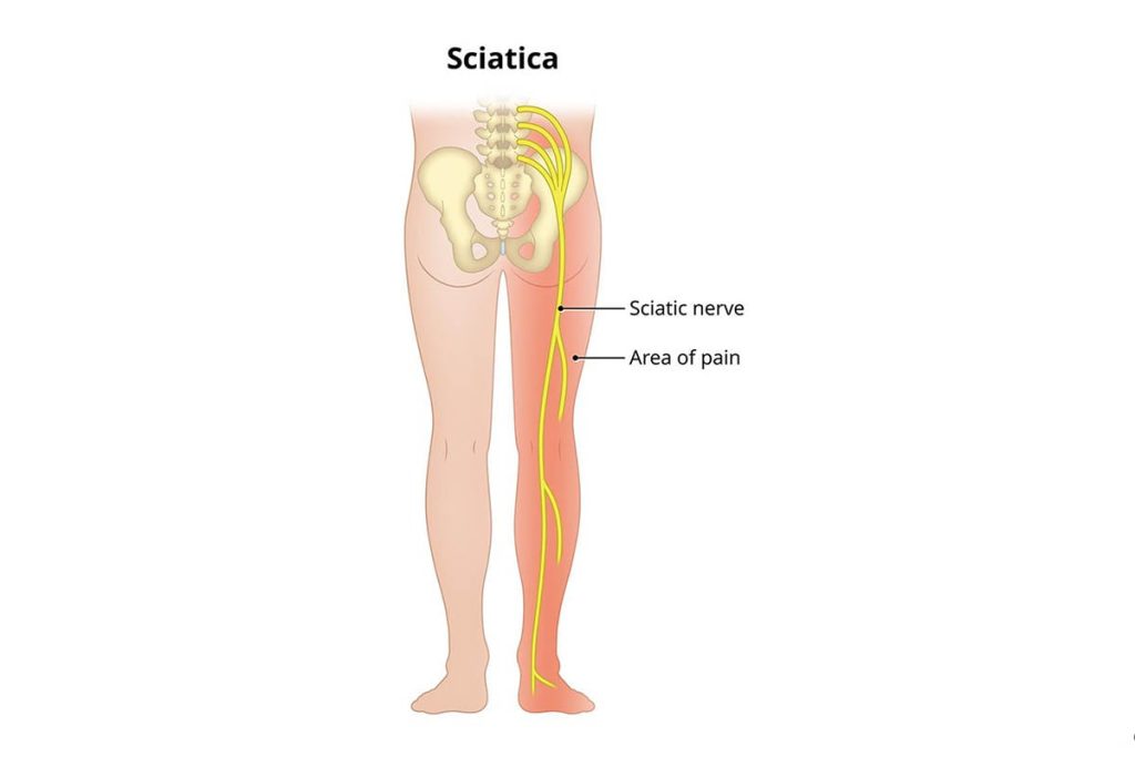 Download Sciatic nerve pain pictures 85 Is Dry Needling an Effective Treatment for Sciatica 3 1