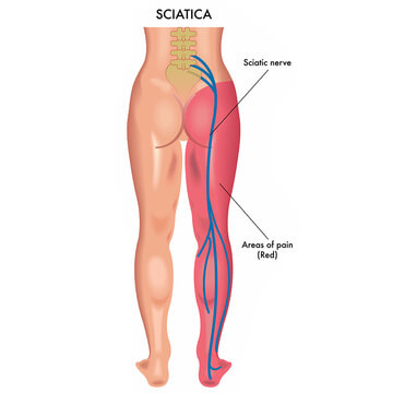 Download Sciatic nerve pain pictures 103 SCIATIC NERVE PAIN