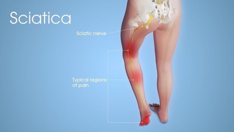 Download Sciatic nerve pain pictures 86 Sciatic Nerve Injury Sciatica