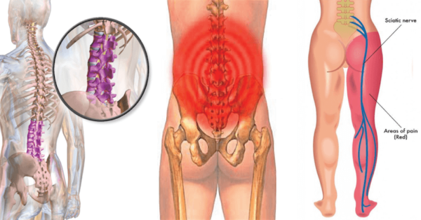 Download Sciatic nerve pain pictures 8 Sciatica Pain 600x314 1