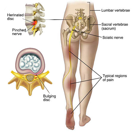 Download Sciatic nerve pain pictures 62 Sciatica Treatment Doctor Back Pain Specialist NYC