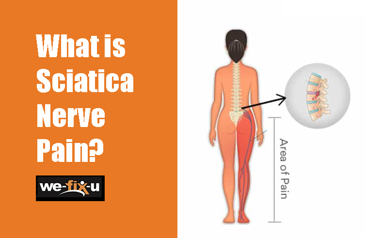Download Sciatic nerve pain pictures 55 Sciatica nerve pain