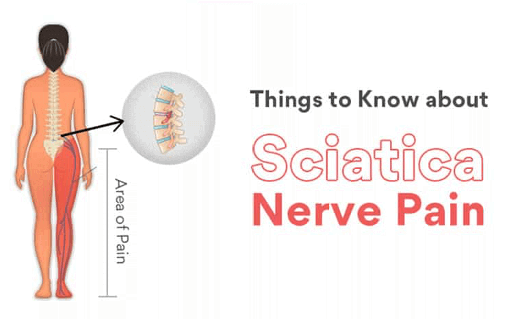 Download Sciatic nerve pain pictures 28 Sciatica
