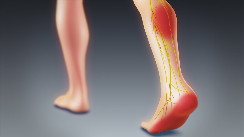 Download Sciatic nerve pain pictures 75 Sciatica2
