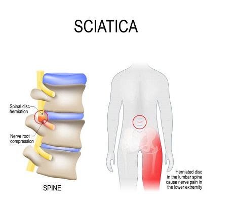 Download Sciatic nerve pain pictures 82 SciaticaPain 1