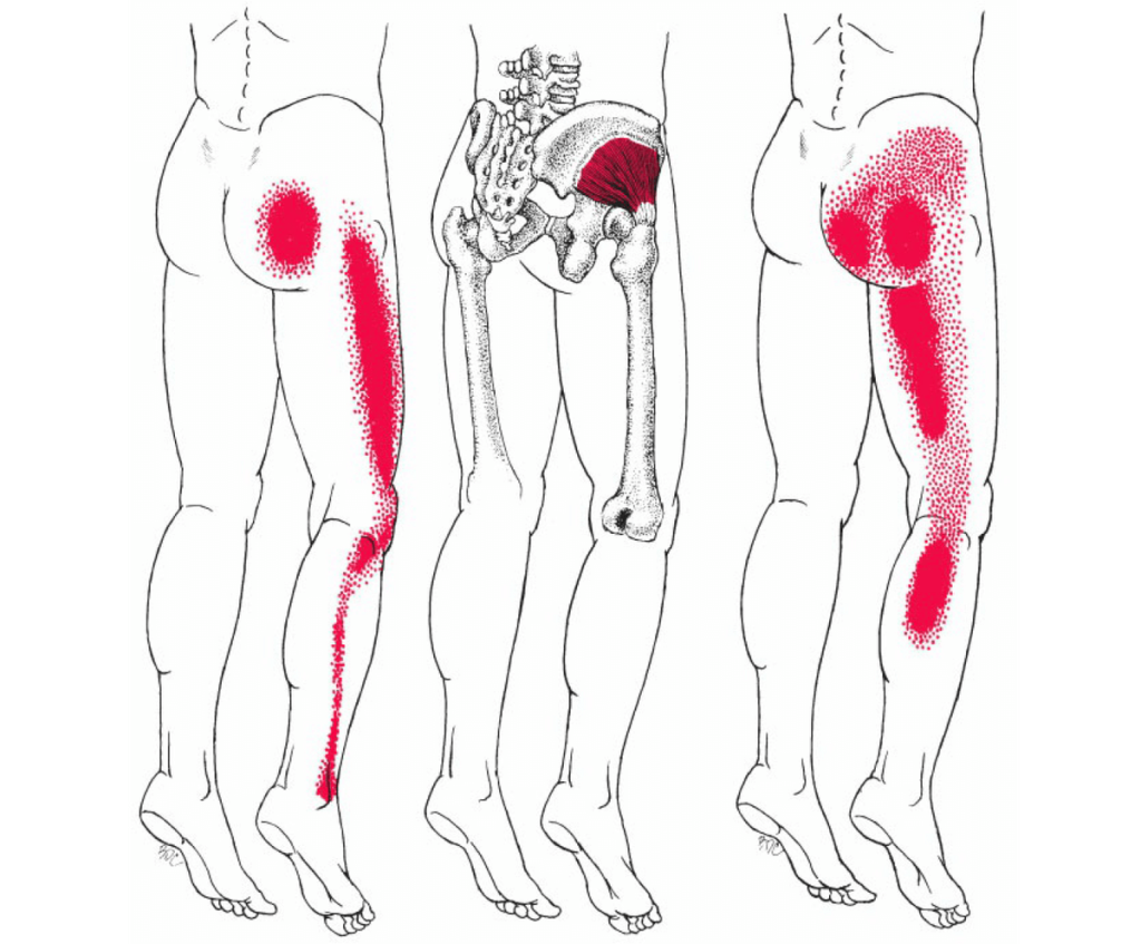 Download Sciatic nerve pain pictures 5 Sciatica Pain Massage 1200x1200