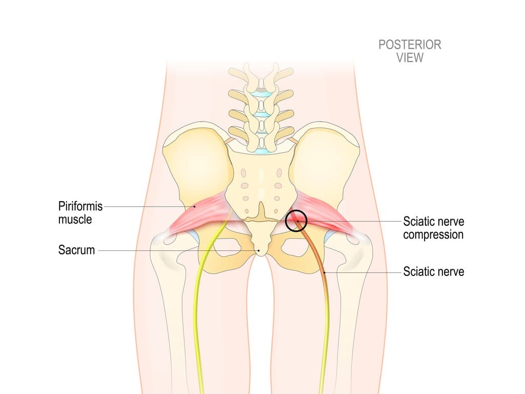 Download Sciatic nerve pain pictures 78 Sciatica hub nerve illustration