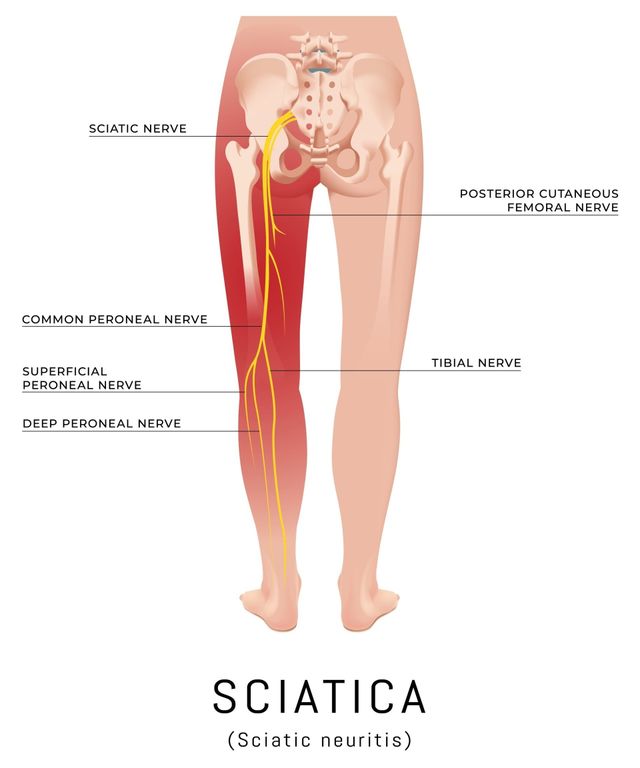 Download Sciatic nerve pain pictures 79 Sciaticapic428429 640w