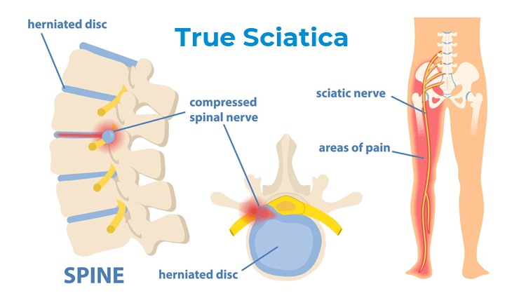 Download Sciatic nerve pain pictures 67 True sciatica1