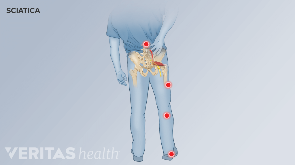 Download Sciatic nerve pain pictures 4 VA 497 SciaticaPainAreas