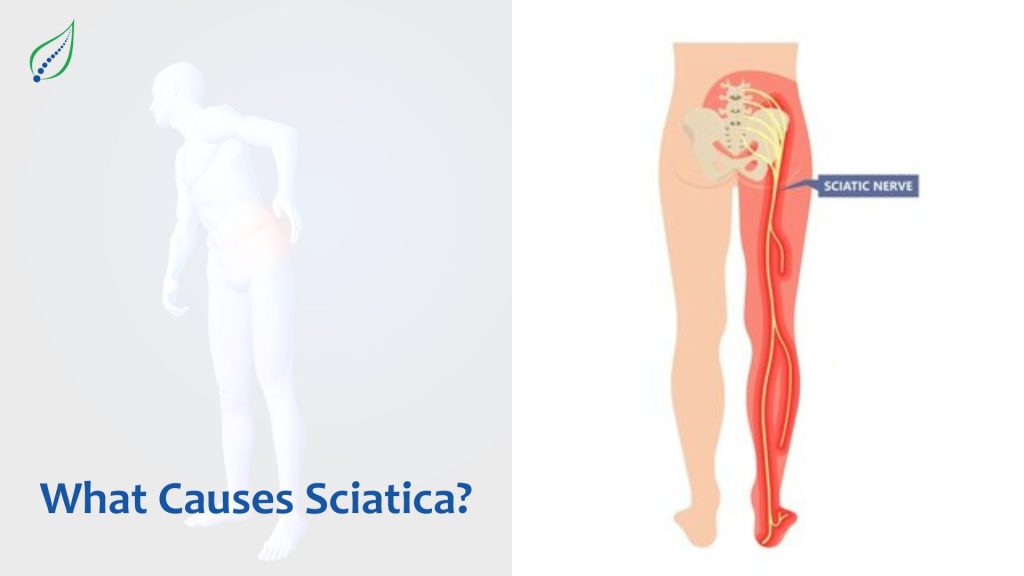 Download Sciatic nerve pain pictures 48 What20Causes20Sciatica 1703593852