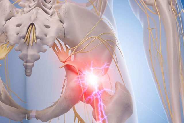 Download Sciatic nerve pain pictures 70 c0f5cb 37986275610a4b0faed48b0dc3be2e44mv2