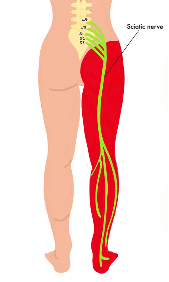 Download Sciatic nerve pain pictures 14 image 22