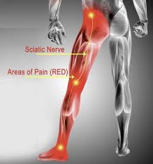 Download Sciatic nerve pain pictures 300 image11