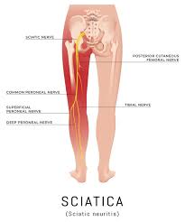 Download Sciatic nerve pain pictures 371 image13
