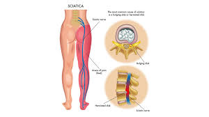 Download Sciatic nerve pain pictures 307 image16