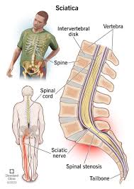 Download Sciatic nerve pain pictures 185 image19