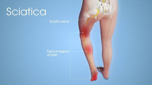 Download Sciatic nerve pain pictures 363 image2