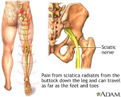Download Sciatic nerve pain pictures 155 image20