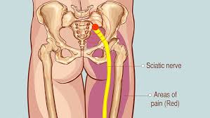 Download Sciatic nerve pain pictures 241 image23