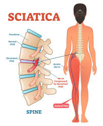 Download Sciatic nerve pain pictures 138 image24