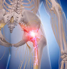 Download Sciatic nerve pain pictures 123 image25