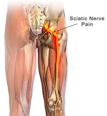 Download Sciatic nerve pain pictures 280 image27