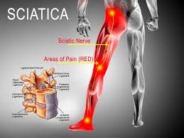 Download Sciatic nerve pain pictures 212 image3