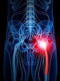 Download Sciatic nerve pain pictures 140 image32
