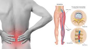 Download Sciatic nerve pain pictures 321 image37
