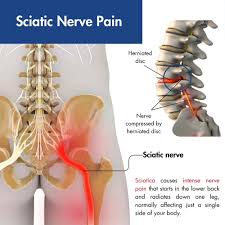 Download Sciatic nerve pain pictures 183 image39