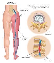 Download Sciatic nerve pain pictures 170 image41