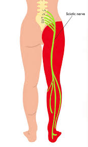 Download Sciatic nerve pain pictures 250 image5