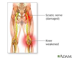 Download Sciatic nerve pain pictures 318 image8