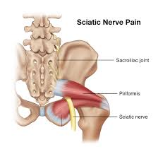 Download Sciatic nerve pain pictures 326 image9
