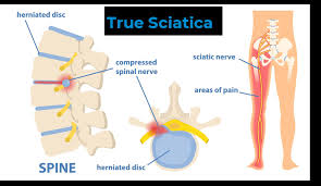 Download Sciatic nerve pain pictures 149 images