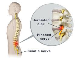 Download Sciatic nerve pain pictures 289 images10