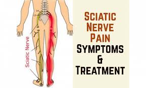 Download Sciatic nerve pain pictures 226 images100