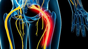 Download Sciatic nerve pain pictures 98 images108