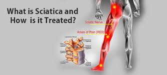 Download Sciatic nerve pain pictures 284 images11