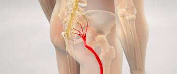 Download Sciatic nerve pain pictures 382 images110