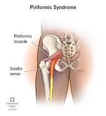 Download Sciatic nerve pain pictures 328 images115