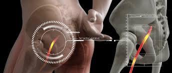Download Sciatic nerve pain pictures 225 images118