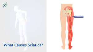 Download Sciatic nerve pain pictures 357 images12