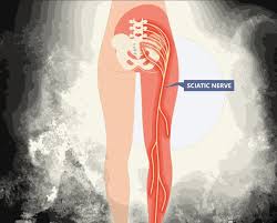 Download Sciatic nerve pain pictures 270 images125