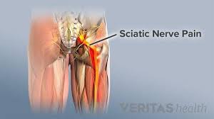 Download Sciatic nerve pain pictures 352 images126