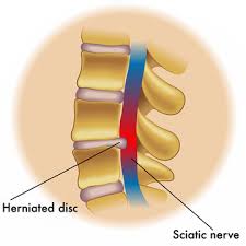 Download Sciatic nerve pain pictures 333 images129